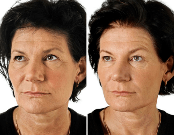 Rezultat frakcijskega pomlajevanja obraza