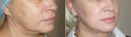 Fotografija po uporabi postopka