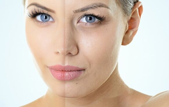 Indikacije za frakcijsko pomlajevanje