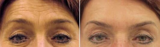 Pomlajevanje polja čela